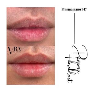 xóa nếp nhăn môi - Plasma fibroblast nano 347 xoa nep nhan moi 10