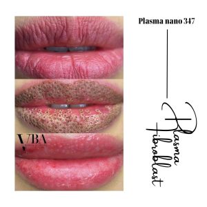 xóa nếp nhăn môi - Plasma fibroblast nano 347 xoa nep nhan moi 11