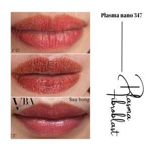 xóa nếp nhăn môi - Plasma fibroblast nano 347 xoa nep nhan moi 12
