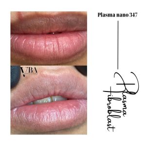 xóa nếp nhăn môi - Plasma fibroblast nano 347 xoa nep nhan moi 9