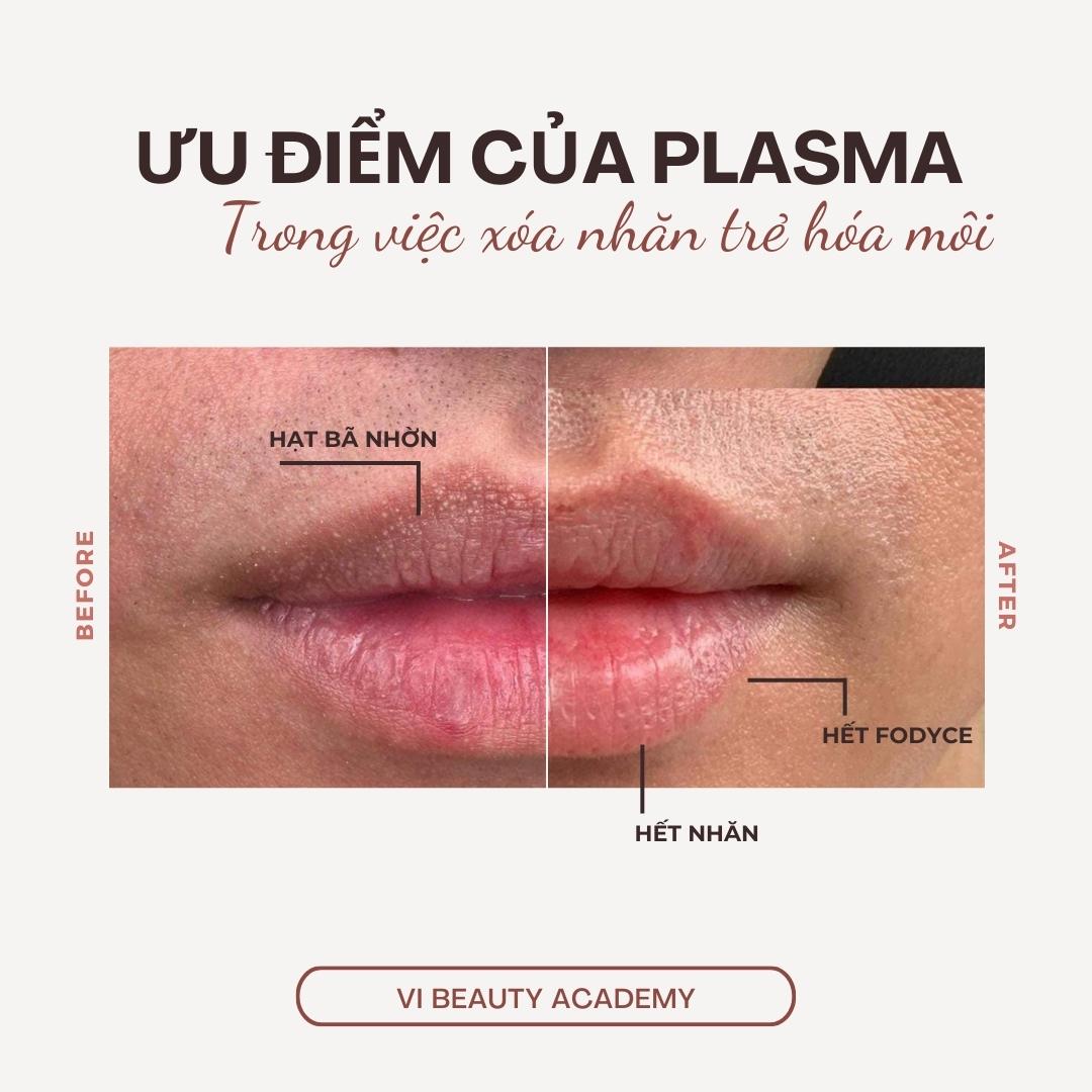 xóa nếp nhăn môi - Uu diem xoa nep nhan moi bang plasma fibroblast